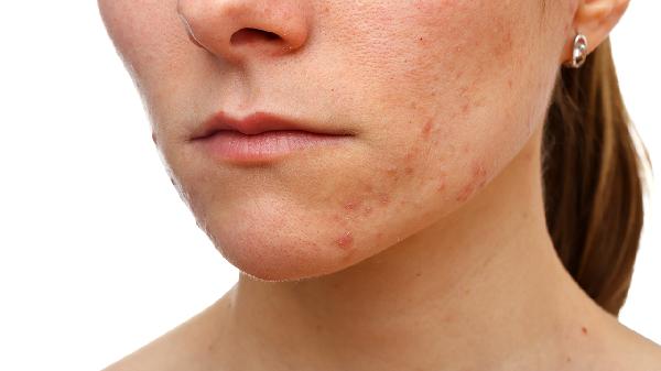 Fade Facial Spots: Quick Tips for Clearer Skin
