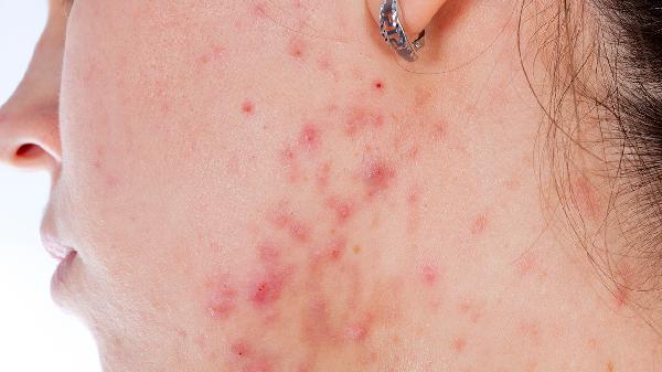 Teen Acne Fixes: Clear Skin Tips for 15-Year-Olds