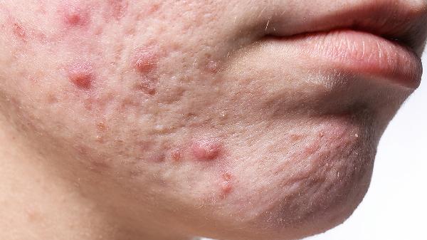 Does Eating Too Much Papaya Cause Chin Acne?