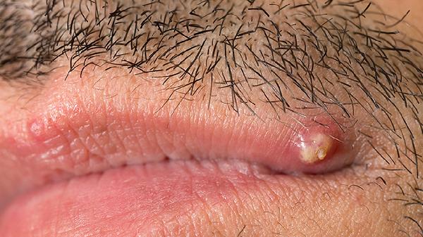 Essential Tips for Men to Prevent Genital Herpes