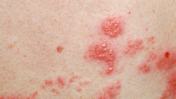 5 Common Foods That Can Help Suppress HIV Naturally