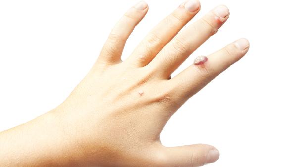 What Tests Are Done for Wart Infections?