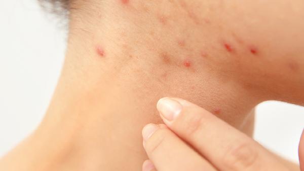 What Causes Genital Herpes? Key Factors Explained