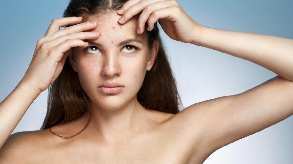 Does Birth Control Clear Up Acne? What You Need to Know