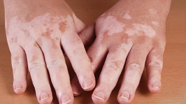 3 Easy Tips to Soothe Your Baby's Dry, Cracked Skin