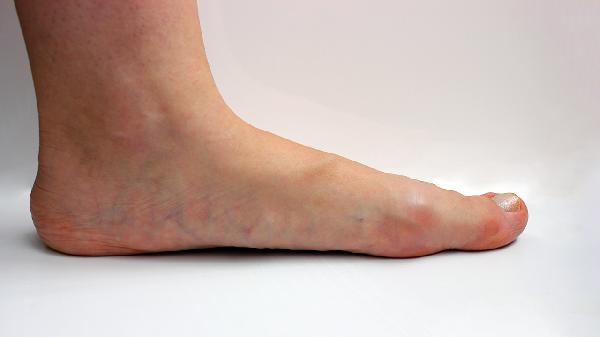 How to Reduce Swollen Feet in Seniors: Quick Relief Tips