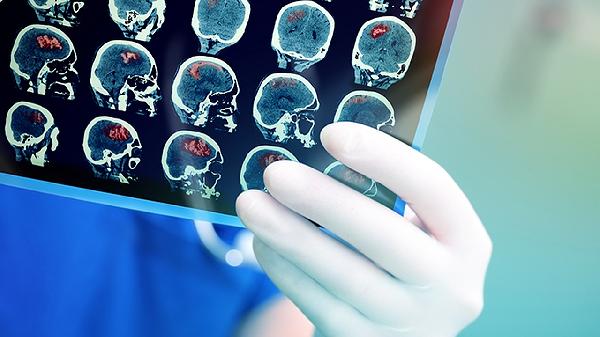 Could Choking While Eating Signal a Stroke in Seniors?