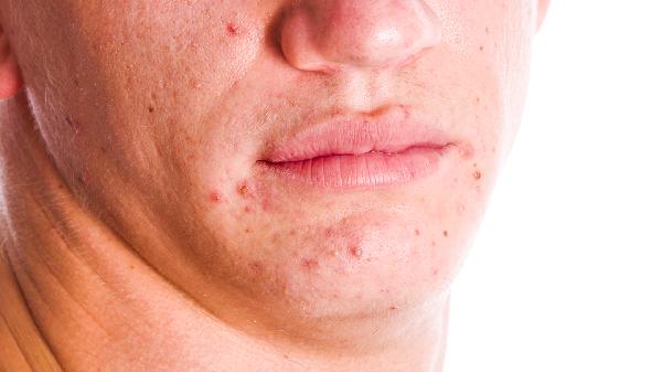 Beat Everyday Allergies with These Simple Tips