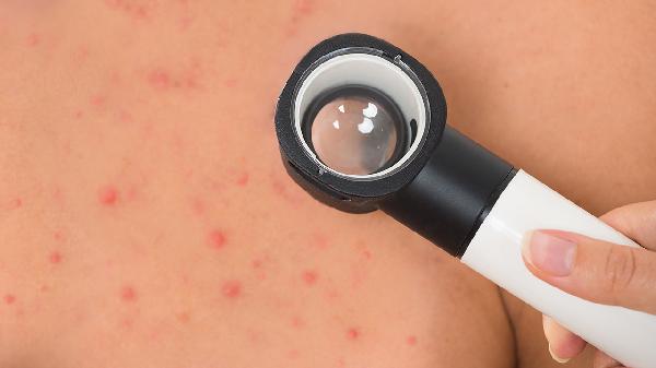 Daily Tips to Combat Skin Allergies Like a Pro