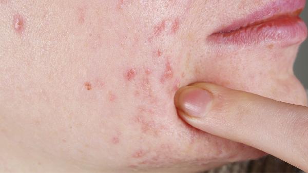 Home Care Tips to Prevent Allergies for Patients