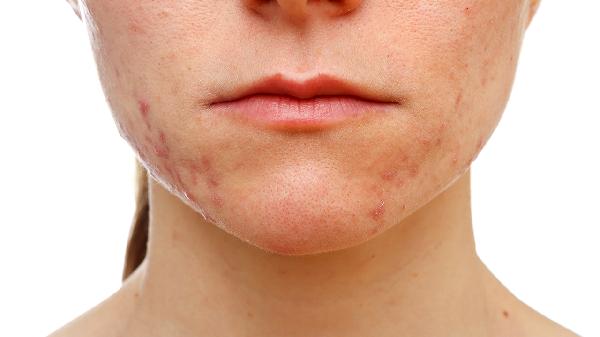 Diet Tips for Allergy Sufferers: Eat Smart, Stay Safe