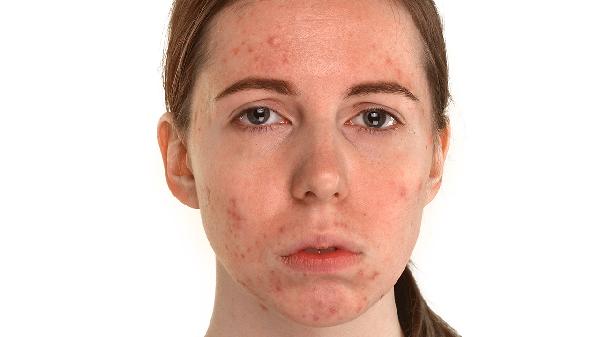 Top Tips to Prevent Metal Allergies Like a Pro