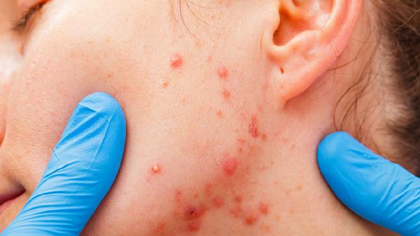 Top Fruits That Trigger Allergies in the U.S.