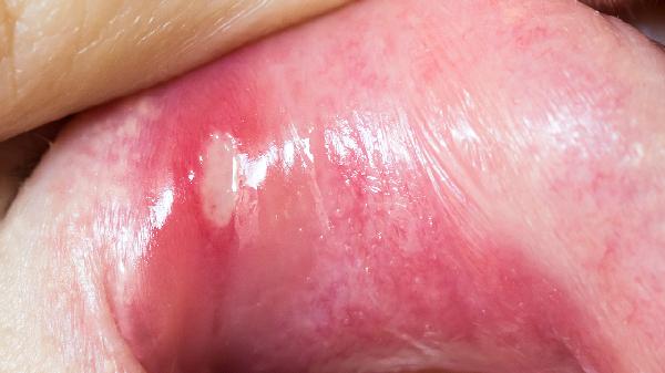 Why Do Teeth Turn Yellow? Uncover the Causes Behind Stained Smiles