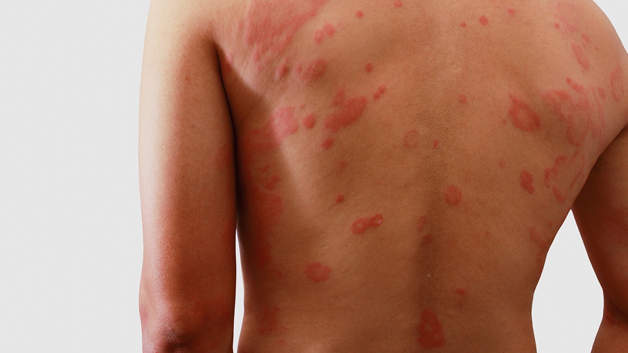 Syphilis' Devastating Impact on the Body Unveiled