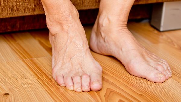 Understanding Varicocele: Symptoms, Causes, and Treatment Options