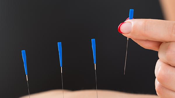 Where to Find the Best Acupuncture Near You