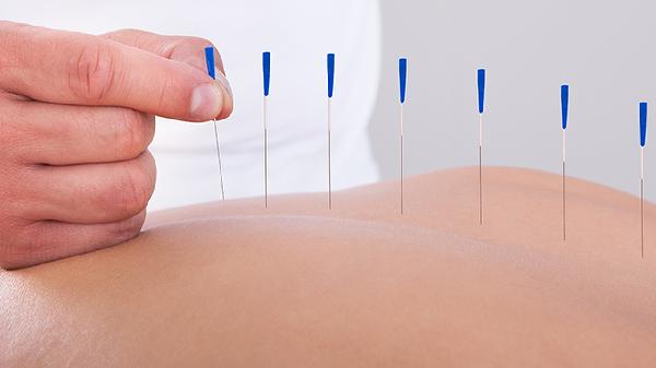 What Are the Top Acupuncture Techniques for Ultimate Relief?