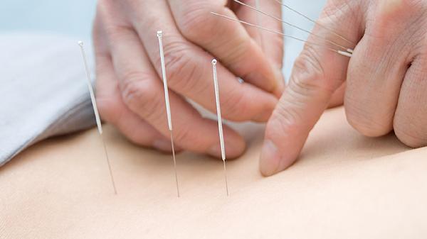 Is Dry Needling Just Like Acupuncture?