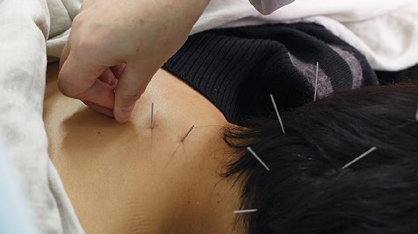 Can Acupuncture Relieve Carpal Tunnel Pain?
