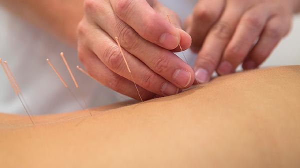 What’s the Difference: Dry Needling vs. Acupuncture?
