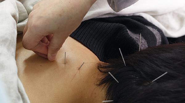 Dry Needling vs Acupuncture: What’s the Difference?