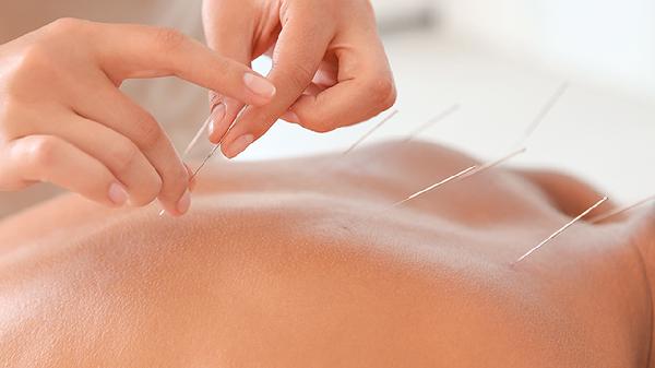 Can Acupuncture Really Help Beat Insomnia?