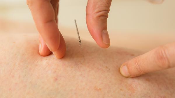 Can Acupuncture Really Ease Your Neck Pain?